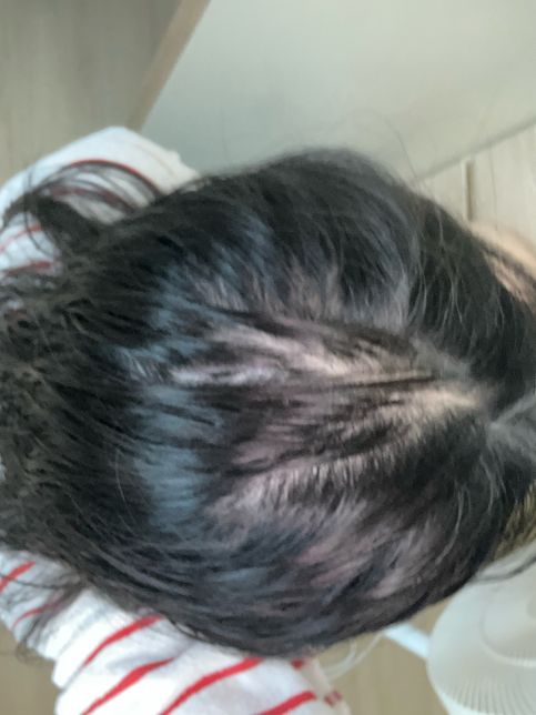 이거 탈모인가요????..?.?의 1번 째 이미지