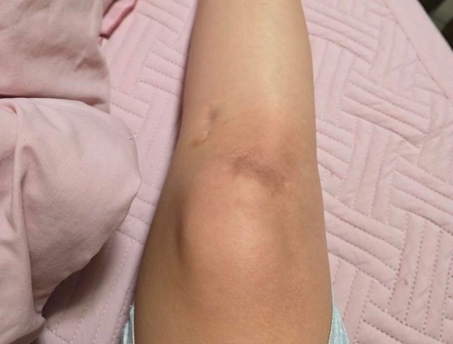 오래된 갈색흉터엔 멜라노사가 나을까요, 노스카나가 나을까요의 0번 째 이미지