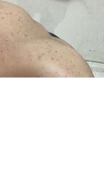 스테로이드제 복용후 가슴과 등에 빨간 여드름이 너무 많이나요....의 1번 째 이미지