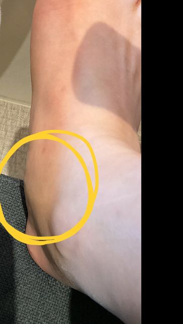 운동을 할 때 발이 너무 아파서, 끝나고 보니까 동그라미 친 부분이 엄청 부어있더라고요ㅠㅠ 운동할 때 계속 뛰는데 신발이 작은 건가 해서 신발의 0번 째 이미지