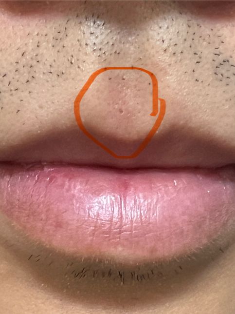 인중 여드름 흉터? 아니면 다른것 일까요의 0번 째 이미지