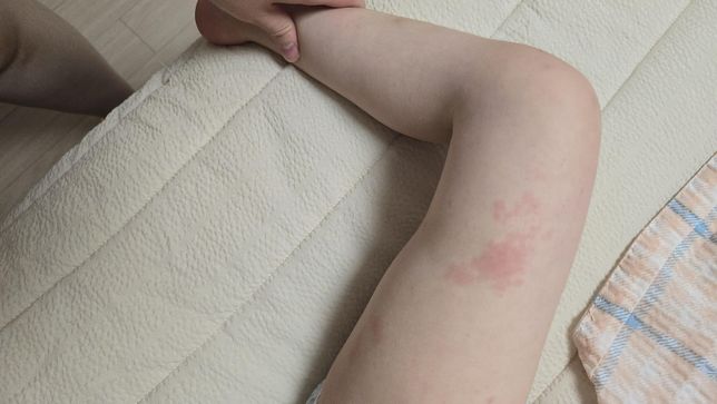 아이 셉트린정 피부발진 문의드립니다의 0번 째 이미지