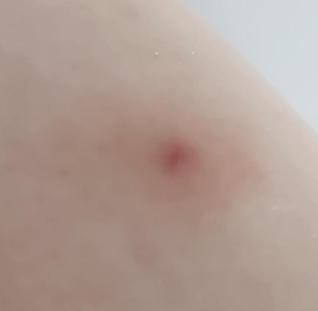 모기물린게맞나요ㅠㅠ물린자국 봐주세요의 1번 째 이미지