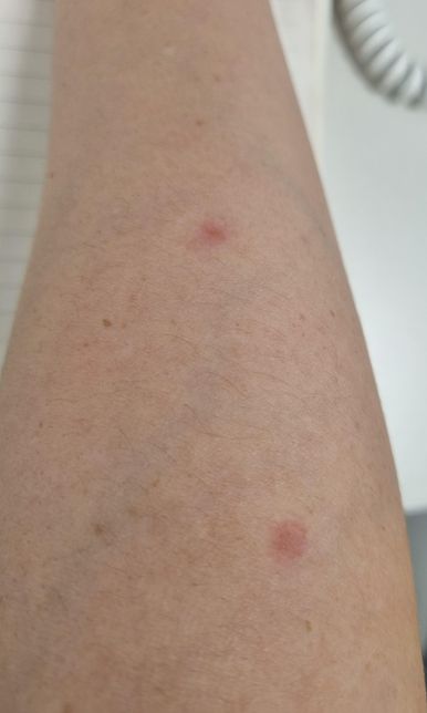 멜라논 크림을 바르고나서 빨개졌어요의 0번 째 이미지