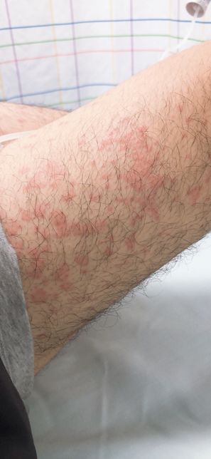 손과 발에서부터 두드러기 같은 게 몸으로 번져요의 0번 째 이미지