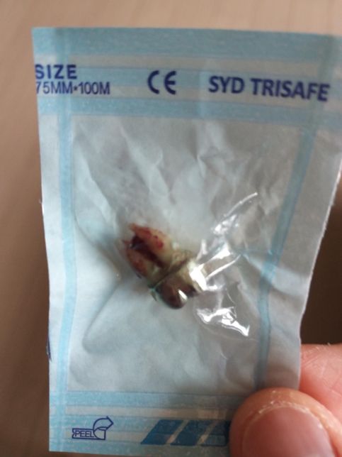 이번에 뺀 금니 팔려고 하는데 질문드려요의 0번 째 이미지