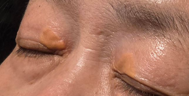 눈꺼풀에 난 의문의 잡티? 제거시술 질문의 2번 째 이미지