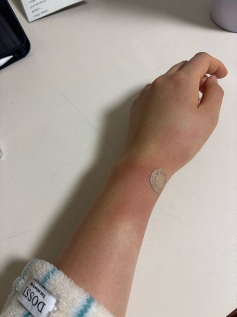 마취 주사 (혈관 터짐, 알러지반응) 의료 보상의 0번 째 이미지