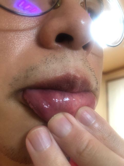 오라메디 페리덱스 사용기간에 관해서 질문드립니다.의 1번 째 이미지