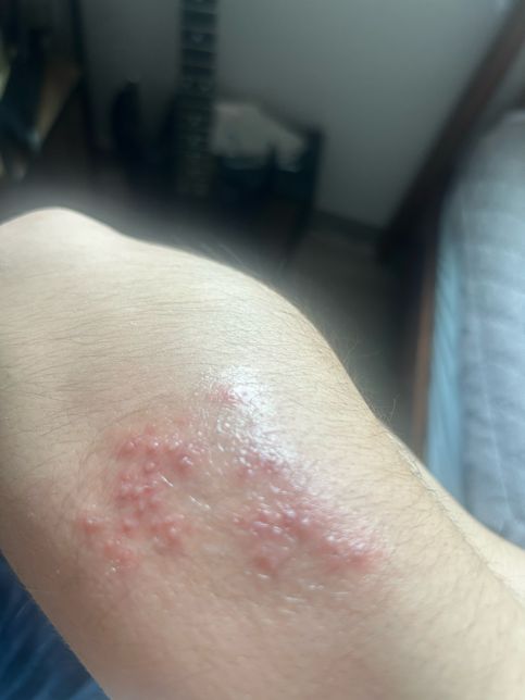 이정도 크기에 연고를 바르고 뭘 붙이는게 나을까요?의 0번 째 이미지