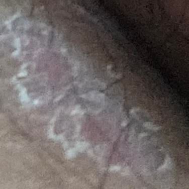 엉골사이에 좀 간지러워서 봤더니 모기물린곳이 건조해진거같은 느낌의 0번 째 이미지