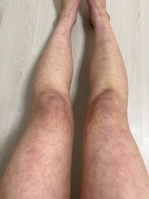 다이어트약 오남용으로 나타나는 증상 질병 유추하여 병원 알려주세요..의 1번 째 이미지