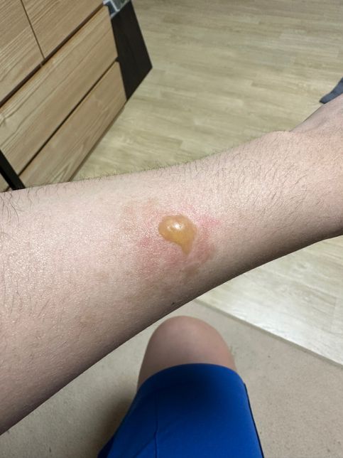 피부과에서 의료사고로 심재성 2도 화상 피해 보상 얼마 청구 해야할까요 ?의 1번 째 이미지