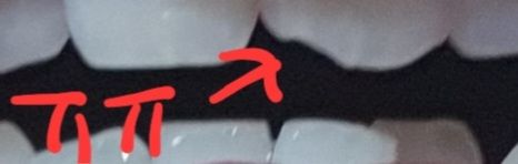 알바하다가 앞니가 깨졌는데 산재처리같은걸 받을 수 있나요?의 0번 째 이미지