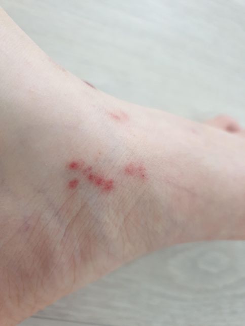 피부좀 봐주세요. 왜 이러는걸까요? 5월부터 시작되었어요의 0번 째 이미지