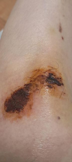 무릎찰과상인데 상처 괜찮은지 봐주세요의 1번 째 이미지