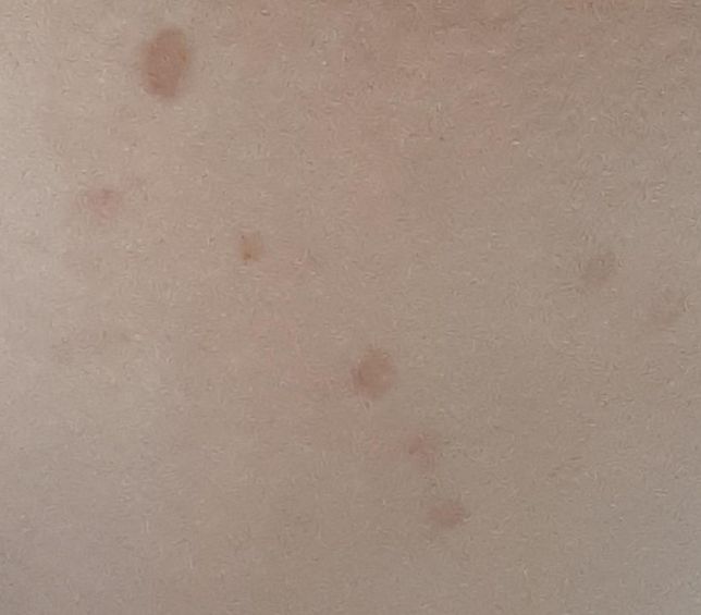 "다시 질문합니다." 겨드랑이 밑에 갈색 반점이 여러개가 갑자기 났어요.의 0번 째 이미지