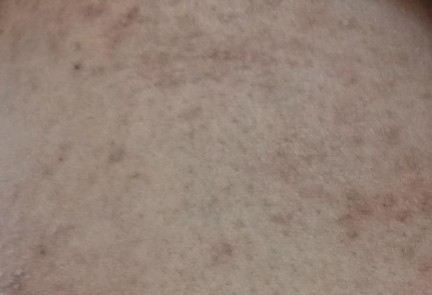 증상과 바르는약을 어떤걸 사용해야 하나요?의 0번 째 이미지