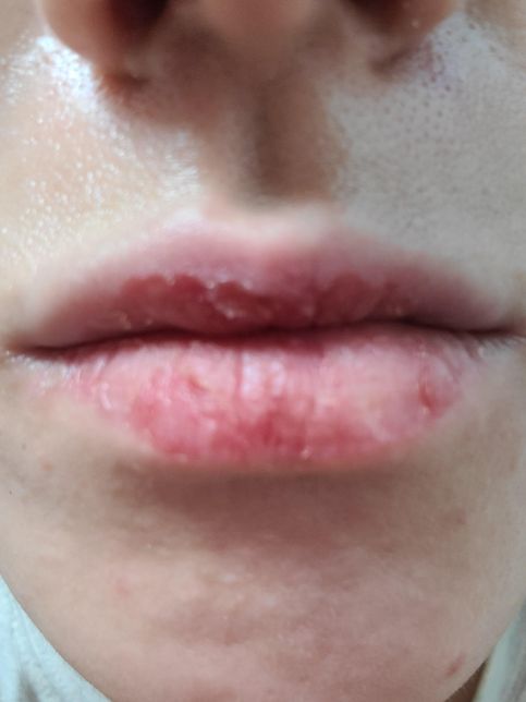 입술뜯는 버릇때문에 미치겠습니다 고치려면 어떻게 하죠의 0번 째 이미지