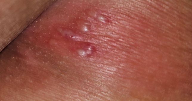 항문 입구 주변에 대상포진처럼 보이는 병변이 생겼습니다의 0번 째 이미지