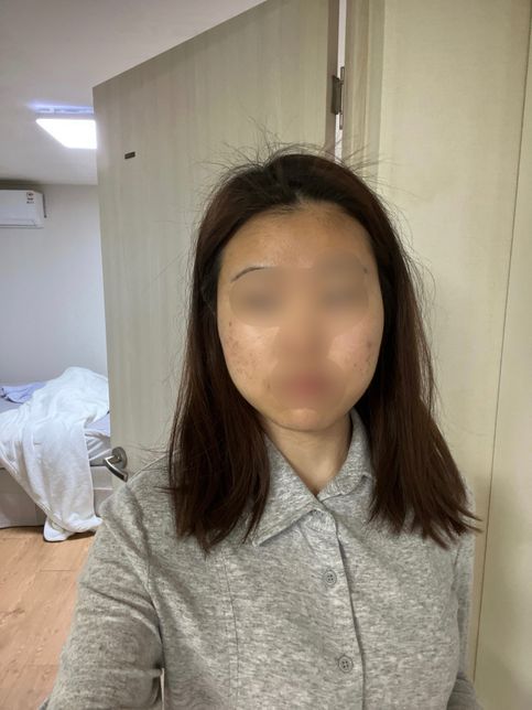얼굴살 없애려고 시술 해야할까요??의 0번 째 이미지