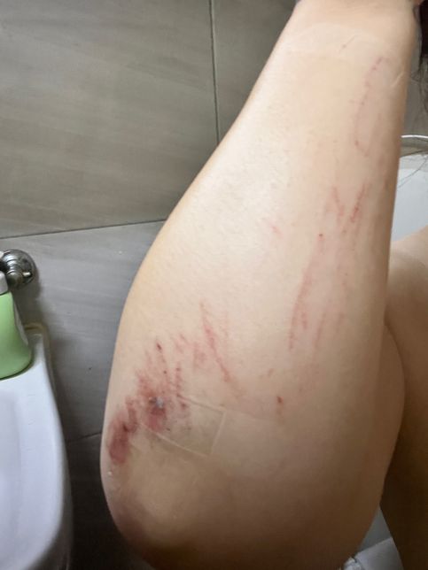 쿠팡물류센터 일용직 하루나가서 다쳣는데 산재될까요ᩚ?의 1번 째 이미지