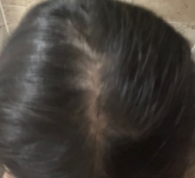 이거 탈모인가요????..?.?의 0번 째 이미지