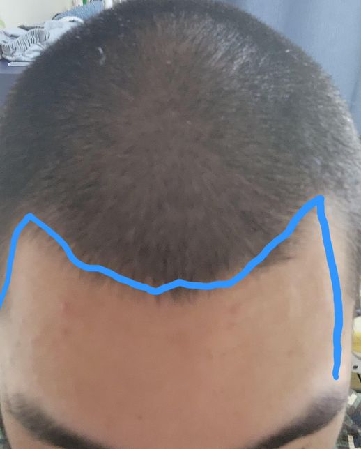 이거m자 탈모인가요 알려주세요!!의 0번 째 이미지