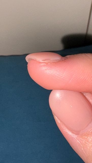 젤 네일 바른 검지손톱 측면에 검은부분 왜이러나요 곰팡이 인가요의 3번 째 이미지