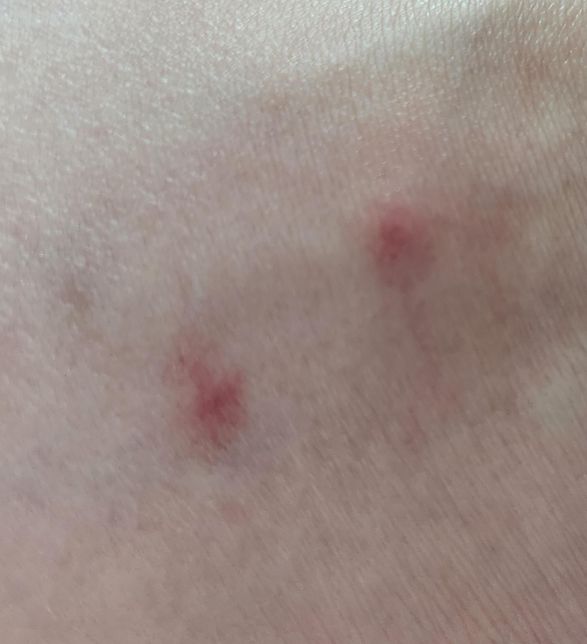 모기물린게맞나요ㅠㅠ물린자국 봐주세요의 0번 째 이미지