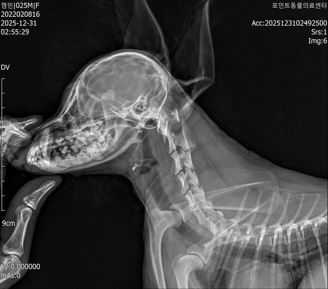 척수증, 척수연화증 판정 받았습니다만, 제가 저희 아이 CT사진을 확인했을때 환축추아(AAI)로도 의심해볼 수 있을거같은데 도움이 필요합니다,,의 1번 째 이미지