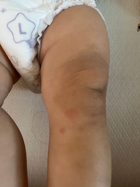 아기 팔다리에 자꾸 모기도아닌데 뭐가물려잇는데 뭘까요?의 0번 째 이미지