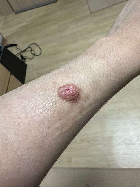 피부과에서 의료사고로 심재성 2도 화상 피해 보상 얼마 청구 해야할까요 ?의 3번 째 이미지