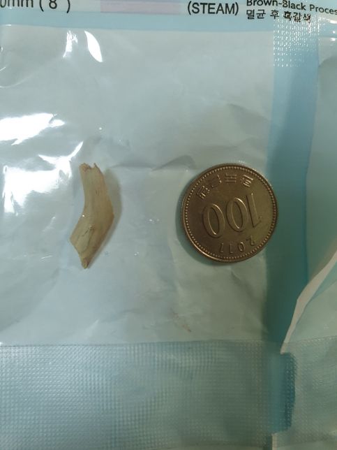 팔 이물질 제거 수술을 했는데 또 이물질이 나와 재수술 했어요의 0번 째 이미지