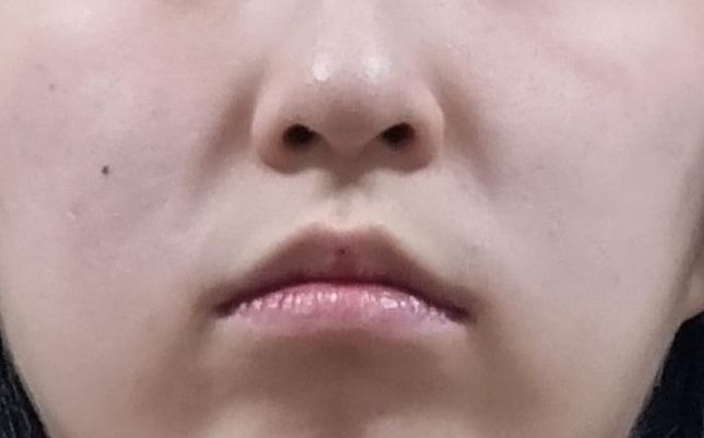 나이에 비해 얼굴 팔자주름이 진하고..의 0번 째 이미지