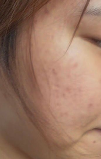 볼에 여드름 있는데 마스크 쓰고 다녀야할까요?의 0번 째 이미지