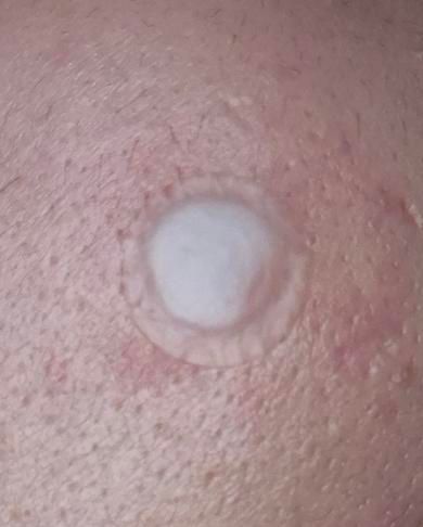 여드름 압출후 여드름패치 교체 궁금해요의 1번 째 이미지