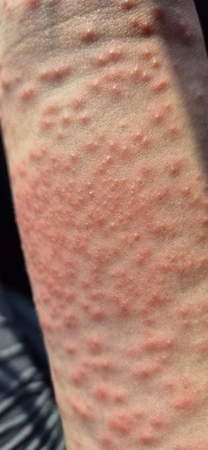 접촉성피부염 증상이 너무 심해요...주사 하루에 두번도 괜찮을까요?의 2번 째 이미지