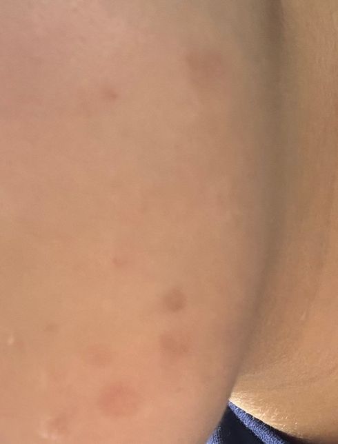 여드름흉터가 갈색으로 색소침착된거는 어떤 연고를 사용해야하나요?의 0번 째 이미지