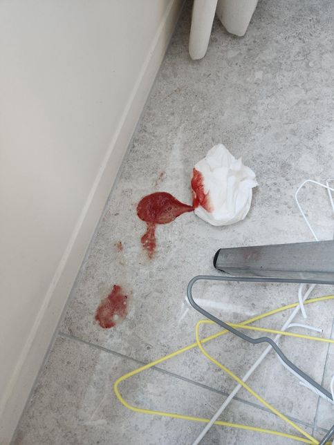 아이가 토를 했는데 피 같은게 나왔습니다의 0번 째 이미지