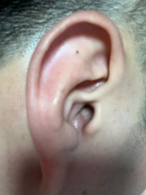 현 보험으로 , 귀종기 (절개)하는 수술 보상받을수있을까요?....의 0번 째 이미지