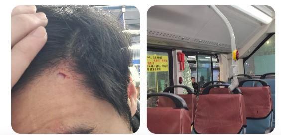 버스에서 가는중에 유리가 깨져 이마가 찢어져 꿰맸는데 버스에 치료비 청구 외 실비나 다른거 받을 수 있을까요?의 0번 째 이미지