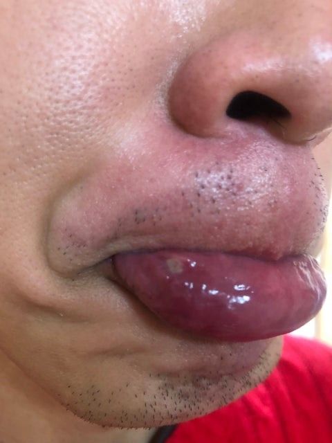 오라메디 페리덱스 사용기간에 관해서 질문드립니다.의 0번 째 이미지