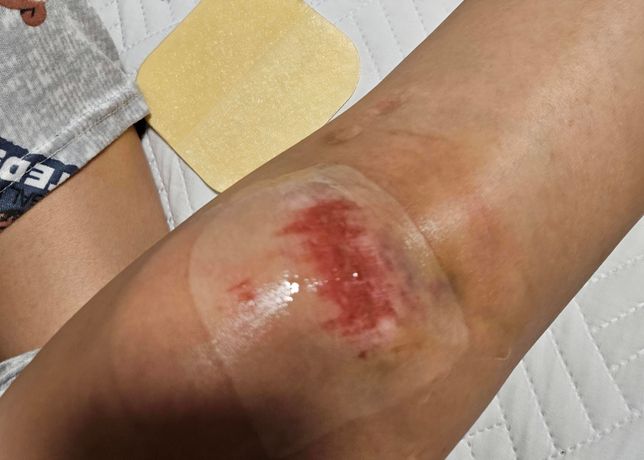 오래된 갈색흉터엔 멜라노사가 나을까요, 노스카나가 나을까요의 1번 째 이미지