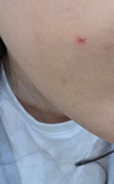 이거 벌레가 문 자국일까요 아님 긁힌상처일까요??의 0번 째 이미지