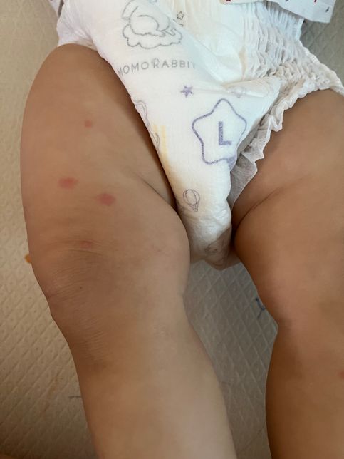 아기 팔다리에 자꾸 모기도아닌데 뭐가물려잇는데 뭘까요?의 1번 째 이미지