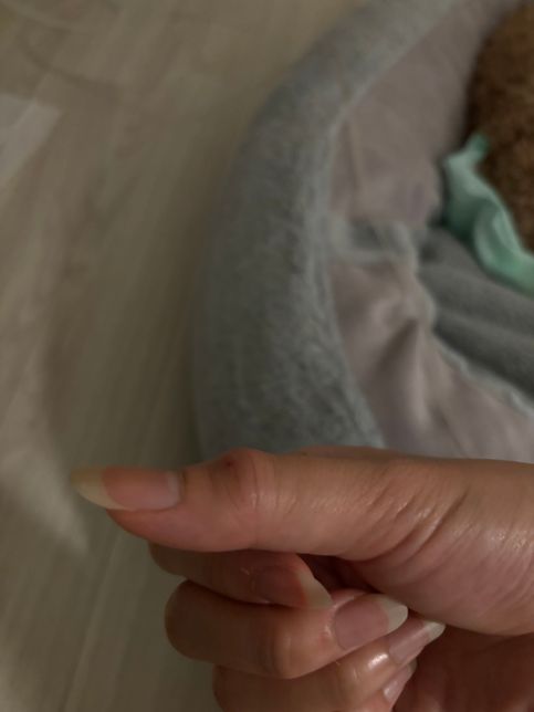 강아지에게 물리고 땡땡 부어올랐어오의 0번 째 이미지