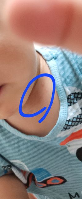 땀띠난곳을 긁고 모기물린형태처럼 되었다가 없어졌어요의 0번 째 이미지