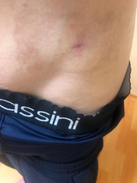 피지낭종 제거후 흉터 연고를 발라야 하는지 질문드립니다.의 0번 째 이미지