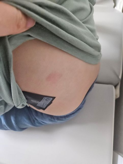 노테몬패취 0.5mg 하루정도 붙였는데 빨개졌어요의 0번 째 이미지